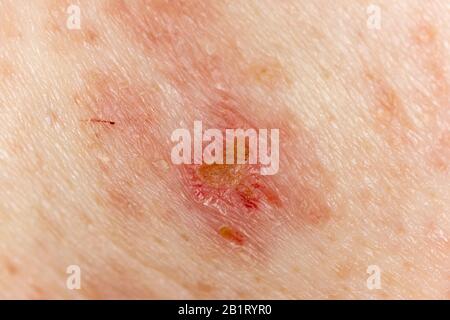 Schindeln Herpes Zoster-Infektion Ausschlag Kaukasion männlich 59 Jahre alt Stockfoto