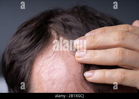 Nahaufnahme der junge Mann die Kontrolle Haarlinie zu Hause Stockfoto