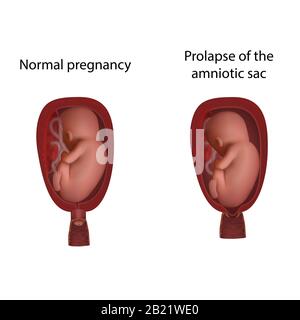 Fruchtblase und normale Schwangerschaft, Abbildung Stockfoto