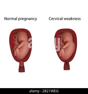Halsschwäche und normale Schwangerschaft, Abbildung Stockfoto