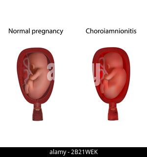 Choroiamnionitis und normale Schwangerschaft, Abbildung Stockfoto