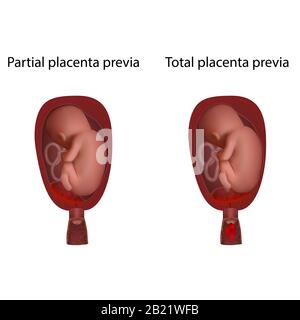 Partielle und totale Plazenta-Prävia, Abbildung Stockfoto