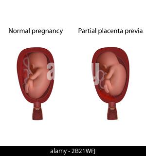 Partielle Plazenta prävia und normale Schwangerschaft, Abbildung Stockfoto