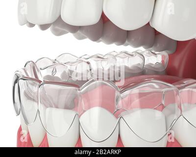 3D-Blendenrendering mit abnehmbarer Halterung für invisalign über weißem Hintergrund Stockfoto