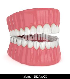 3D-Blendenrendering mit abnehmbarer Halterung für invisalign über weißem Hintergrund Stockfoto