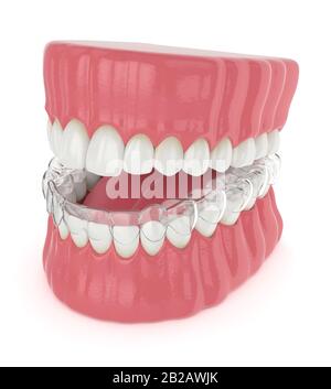 3D-Blendenrendering mit abnehmbarer Halterung für invisalign über weißem Hintergrund Stockfoto