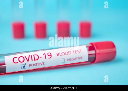 Coronavirus Kovid 19-infizierte Blutprobe im Probenröhrchen. Coronavirus Kovid-19-Impfstoffforschung. Krankenhaus konzeptionell. Hintergrund der Klinik. Epidemie, Pandemiehintergrund. Diagnose Stockfoto