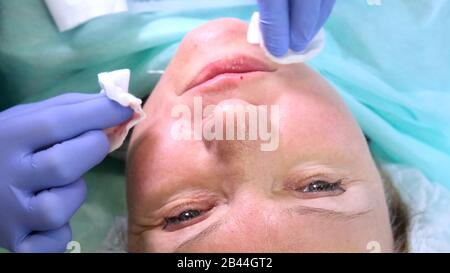 Der Kosmetologe Doktor bereitet das Gesicht einer Frau auf eine kosmetische Injektion vor, Injektionen von Hyaluronsäure. Frau in einem Schönheitssalon. Klinik für plastische Chirurgie Stockfoto