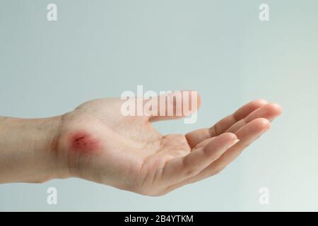 Die Kratzwunde am Handcloseup der Frauen, dem Konzept des Gesundheitswesens und der Medizin Stockfoto