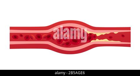 Blockierte Blutgefäßarterie mit Cholesterinansammlungen, die Blockierung der Arterienthrombose medizinisches Konzept horizontale Vektordarstellung verursachen Stock Vektor