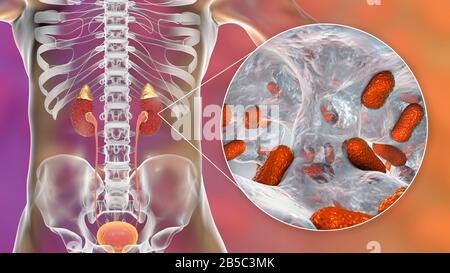 Akute Pyelonephritis, verursacht durch Acinetobacter-Bakterien, illus Stockfoto