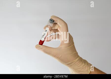 Laborprobe der Blutuntersuchungen zur Diagnose neue Corona-Virusinfektion COVID-19 aus Wuhan, China. Pandemic Infektionskonzept. Stockfoto