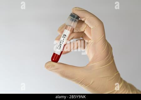 Laborprobe der Blutuntersuchungen zur Diagnose neue Corona-Virusinfektion COVID-19 aus Wuhan, China. Pandemic Infektionskonzept. Stockfoto