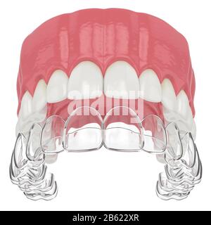 3D-Rendering der Oberkiefer mit abnehmbarer Halterung invisalign über weißem Hintergrund Stockfoto