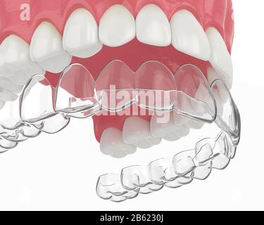 3D-Rendering der Oberkiefer mit abnehmbarer Halterung invisalign über weißem Hintergrund Stockfoto