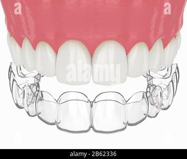 3D-Rendering der Oberkiefer mit abnehmbarer Halterung invisalign über weißem Hintergrund Stockfoto