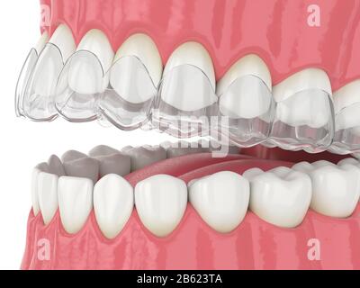 3D-Rendering von invisalign abnehmbarer und unsichtbarer Halterung an der Blende über weißem Hintergrund Stockfoto