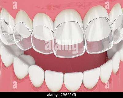 3D-Rendering der Oberkiefer mit abnehmbarer Halterung für invisalign Stockfoto