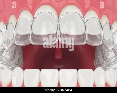 3D-Blendenrendering mit abnehmbarer Halterung für die obere invisalign-ausrichtung Stockfoto