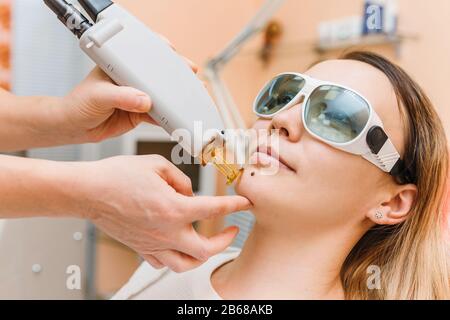 In einer Kosmetologie-Klinik erhält eine Frau eine Behandlung im Gesichtsbereich, der Laser entfernt den Maulwurf Stockfoto