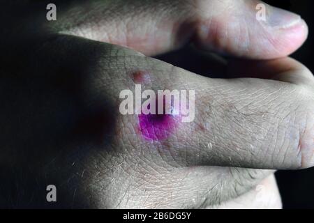 Papillen auf der Haut eines Patienten mit Windpocken Nahaufnahme. Varicella-Zoster-Virus. Stockfoto