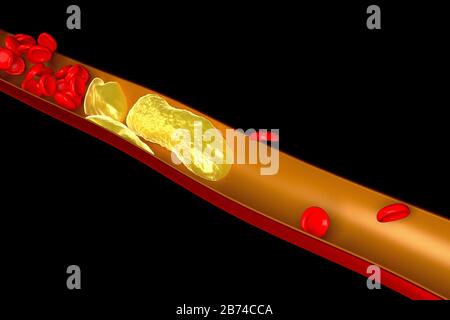 3D-Cholesterin, Gerinnsel, rote Blutkörperchen Stockfoto