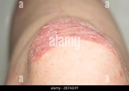 Psoriatische Plaque auf der Haut des Knies. Nahaufnahme. Hautprobleme. Hauterkrankungen.Weichzeichnen Stockfoto