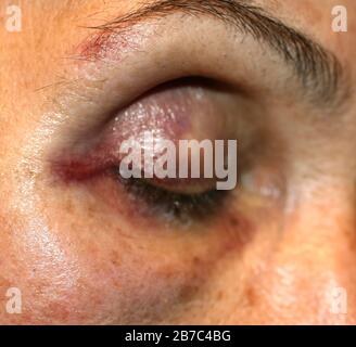 Ein blauer Fleck in der Nähe des Auges. Hämatome im Gesicht bei einem Schlag. Augenverletzungen. Stockfoto