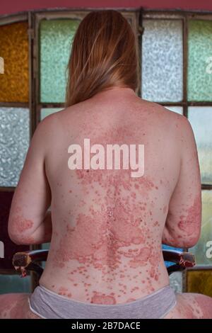 Rückseite der Frau mit Psoriasis, die auf einem Stuhl sitzt Stockfoto