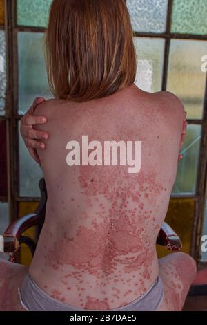 Rückseite der Frau mit Psoriasis, die auf einem Stuhl sitzt Stockfoto