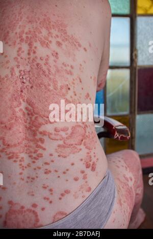 Rückseite der Frau mit Psoriasis, die auf einem Stuhl sitzt Stockfoto