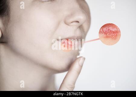 Mädchen mit Herpes. Symptom "krank". Lippen kalt Stockfoto