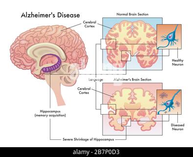 Medizinische Illustration der Alzheimer-Krankheit isoliert auf weiß. Stockfoto