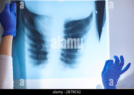Röntgenaufnahme der Lunge in den weiblichen Händen einer medizinischen Fachkraft in blauen Gummi-Einweghandschuhen. Überprüfung der Pneumonie mit Coronavirus. Stockfoto