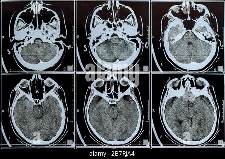 MRT-Scan des Gehirns. MRT-Gehirnscan oder Röntgenneurologie am menschlichen Kopf Schädeltomographie Test. Magnetresonanztomographie. Selektiver Fokus. Stockfoto