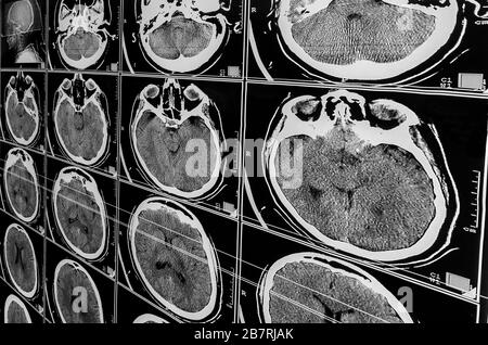 Elektromagnetische Tomographie Gehirn. Sequenz vertikaler Abschnitte eines menschlichen Gehirns - MRT-Messung. Echte Hirn-MRT-Folie eines Mädchens. Minimale Bearbeitung zum Speichern Stockfoto