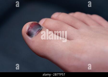 Blauer Zehenschwanz. Gebrochener Finger. Nahaufnahme des verletzten Fußes des Kindes. Farbenfroher Fingernagel auf verschwommem Hintergrund. Stockfoto