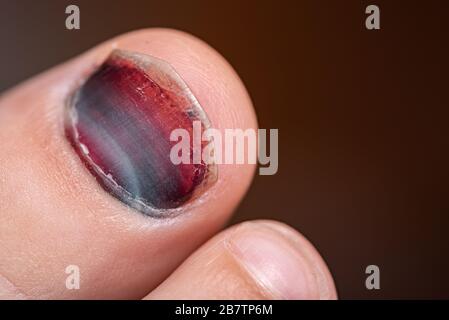 Blauer Zehenschwanz. Gebrochener Finger. Nahaufnahme des verletzten Fußes des Kindes. Farbenfroher Fingernagel auf verschwommem Hintergrund. Stockfoto