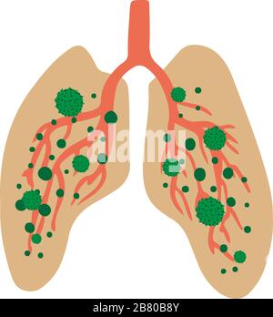 Infizierte Lunge mit Coronavirus 2019-NC0V. Stoppen Sie die pandemische COVID-19-Mikrobe mit Ausbruch. Das Virus greift die Atemwege an, Infektionen medizinisches Gesundheitsrisiko. Warnkonzept. Flacher, einfacher Cartoon-Stil Stock Vektor