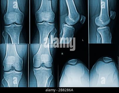 Röntgenbild mit männlichen Knien bei Erwachsenen mit verschiedenen Winkeln. Bilder aus der medizinischen und menschlichen Anatomie. Stockfoto