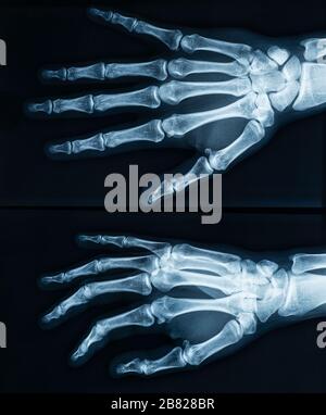 Röntgenbild des rechten Skeletts des menschlichen weiblichen Erwachsenen. Bilder aus der Medizin und Anatomie. Stockfoto