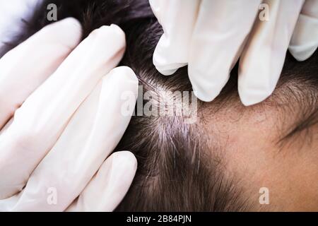 Nahaufnahme DER Hand EINES Dermatologen Behaarung der Haare des Patienten Stockfoto
