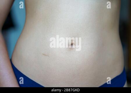 Frauenbauch mit kleinen verheilten Narben nach einer Leistenhernie-Operation. Stockfoto