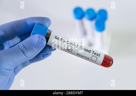 Positives Bluttestergebnis für SARS COV 2, Coronavirus, das die Krankheit Covid 19 verursacht Stockfoto