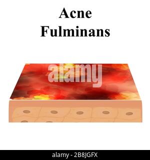 Zyste Akne. furonheim Acne auf der Haut Zysten und Pickel. Dermatologische und kosmetische Entzündungserkrankungen auf der Haut des Gesichts. Infografiken Stock Vektor