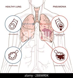 Eine schematische Darstellung des menschlichen Körpers mit einer Infografik der Symptome des Coronavirus kovid 19. Stock Vektor