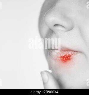 Mädchen mit Herpes. Symptom "krank". Lippen kalt Stockfoto