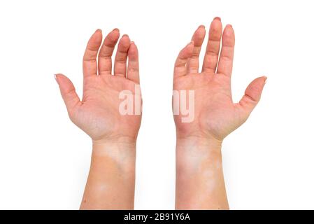 Flecken von Vitiligo an der Innenseite der Hände und Unterarme einer jungen kaukasischen Frau, isoliert auf weißem Hintergrund mit einem Beschneidungspfad. Stockfoto