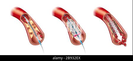 Medizinische Darstellung der Ballonangioplastie und der Stent-Einstülpung Stockfoto