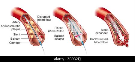 Medizinische Darstellung der Ballonangioplastie und der Stent-Einstülpung Stockfoto